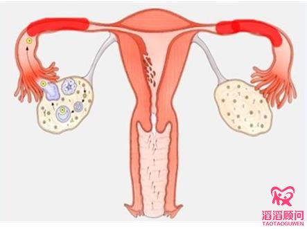 输卵管堵塞怎样疏通才行?