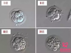 第三代试管婴儿囊胚检测怎么样？