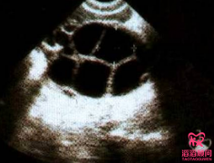 试管婴儿促排取卵大揭秘!背后藏着哪些不为人知的秘密?